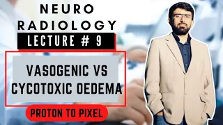 Difference b/w Vasogenic and Cytotoxic Edema | Vasogenic Cerebral Edema | Cereberal Oedema |