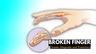 Broken finger, Causes, Signs and Symptoms, Diagnosis and Treatment.