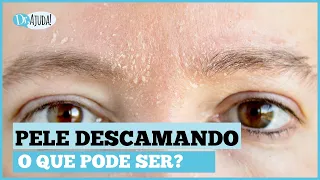 PELE DESCAMANDO: CAUSAS, SINTOMAS E O QUE FAZER?