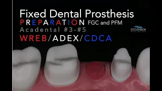 Fixed Dental Prosthesis Preparation - #3-#5 Acadental | WREB-ADEX-CDCA