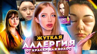 РЕАКЦИЯ НА ОПУХЛА ГОЛОВА ОТ ДЕШЕВОЙ КРАСКИ ДЛЯ ВОЛОС!!! РЕАКЦИЯ ПАРИКМАХЕРА НА ЖУТКОЕ ОКРАШИВАНИЕ