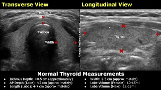 How To Measure Thyroid On Ultrasound | Length, Width, AP Depth & Volume Measurements USG