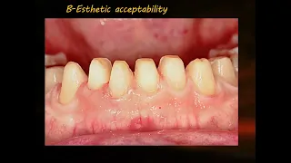 Single Complete Denture || Dr.Alaa Dakhil Algurabi