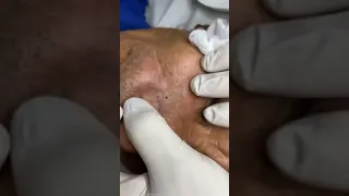 Removendo enormes cravos e espinhas/ blackheads acne