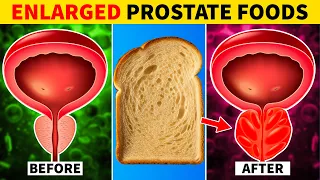 9 Foods to Avoid with an Enlarged Prostate