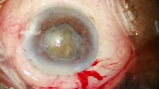 Small pupil Phaco - Hard cataract - demonstrated to Dr Gulzad from Kyrgystan - 4th May, 2024