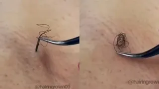 Removing Long Ingrown Hair From Armpit