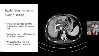 Webinar: Radiation therapy and molecular characterization of cholangiocarcinoma