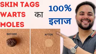 Skin Tags, Warts & Moles का 100% इलाज with Home Remedies