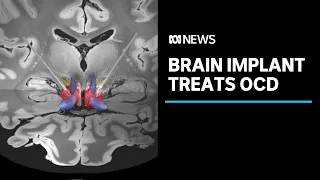 Scientists use brain implants to treat obsessive-compulsive disorder | ABC News