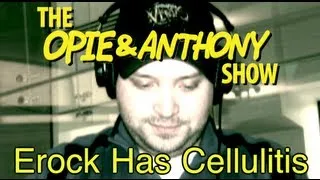 Opie & Anthony: Erock Has Cellulitis (09/28/10)