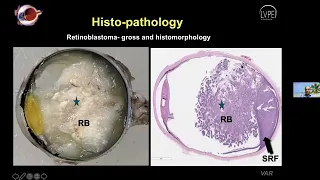 Retinoblastoma: Current Concepts of Management by Oncologist Dr P. Vijay Anand Reddy.