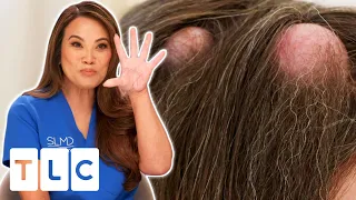 "It's Like Pandora's Box" Dr. Lee Removes Quintuplet Cyst Balls l Dr. Pimple Popper l CENSORED