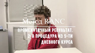 53. Промежуточный результат лечения Тройничного нерва по методу RANC.