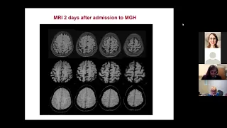 Neurology Grand Rounds: A 65-year-old Woman with a History of Childhood Measles