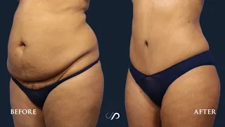 Mommy Makeover: Tummy Tuck & 360 Lipo | Before and After | Dr. David Stoker