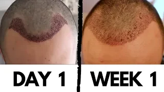 Hair Transplant Results after 1 Week! + How to Remove Scabs and Dry Skin of Implanted Area (DHI)