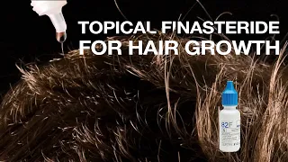 Does Topical Finasteride for Hair Growth have Fewer Side-Effects?