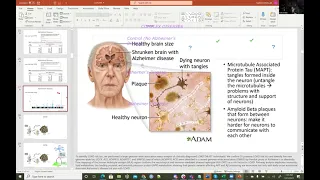 Genome-Wide Association Studies (GWAS) and Alzheimer's