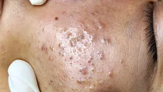 Relaxing Make your Acne Treatment VENREN NGUYEN #429 | Blackheads & Pimple Removal 2022