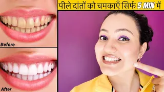 TEETH WHITENING AT HOME (Works 100%) | ALL ABOUT TEETH WHITENING & ORAL HYGIENE