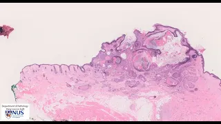 Skin, Squamous cell carcinoma Microscopy - Talking slide