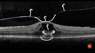 OCT Interpretation - Vitreous