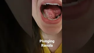 Plunging ranula / Καταδυόμενο βατράχιο