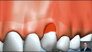 Exposed Tooth Root | Dentist Pasadena Texas