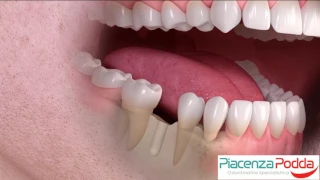 Sostituzione di un dente singolo mediante corona in ceramica su impianto STRAUMANN