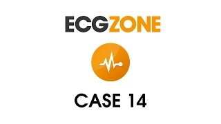 ECG Case 14 - Resolved Chest Discomfort