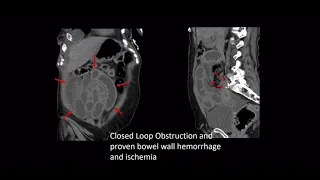 CT evaluation of bowel obstruction and Colitis