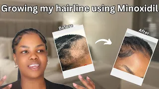 This is how I grew back my hairline/edges.