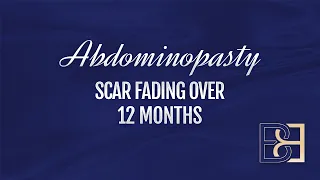 Abdominoplasty scar fading over 12 months