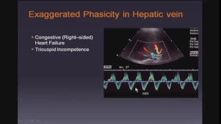 Doppler Ultrasound of the Liver and Portal Hypertension