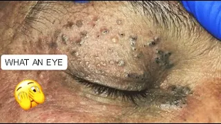 UNBELIEVABLE !!! LOOK AT THIS EYE HOW FULL OF BLACKHEAD😨 Part2 #relaxing #blackheads