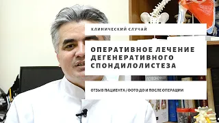 Лечение дегенеративного спондилолистеза и стеноза позвоночника