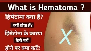 Hematoma क्या है? Blood collection में हिमेटोमा होने के कारण, बचाव के उपाय और होने पर क्या करें?