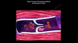 Deep venous thrombosis, blood clots how it happens ,what are the risks of  blood clots