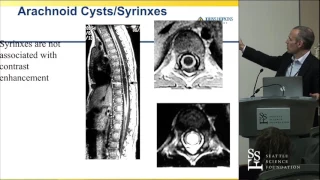 Spinal Cord Tumors - Daniel M. Sciubba, MD