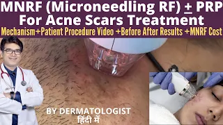 Microneedling RF MNRF Treatment For Acne Scars | MNRF Skin Treatment with PRP | Before After Results