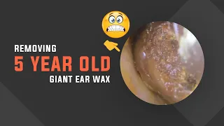 Removing A 5-Year-Old Ear Wax By Dr Raksmey (P04)