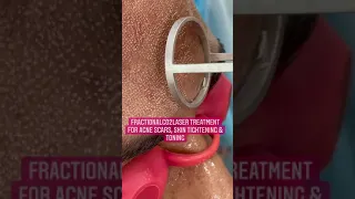 FractionalCO2laser Treatment for Acne Scars| Dermatologist|Skin tightening | Chandigarh #shorts