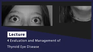 4 Evaluation and Management of Thyroid Eye Disease