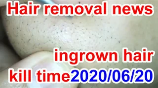 Hair removal news【Ingrown Haｄremoval news,relax time,pull out