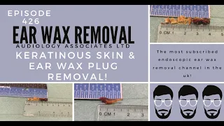 KERATINOUS SKIN & EAR WAX PLUG REMOVAL - EP426