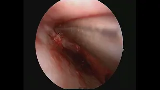 Endoscopic Septoplasty: Surgical video