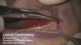 Lateral Canthotomy / Cantholysis: Two step technique