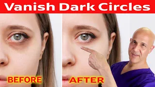 Vanish Dark Circles Naturally Within 1 Week!  Dr. Mandell