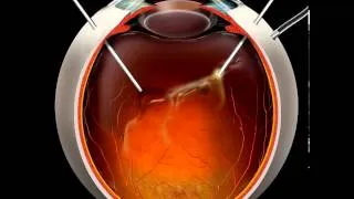 Vitrectomy animation